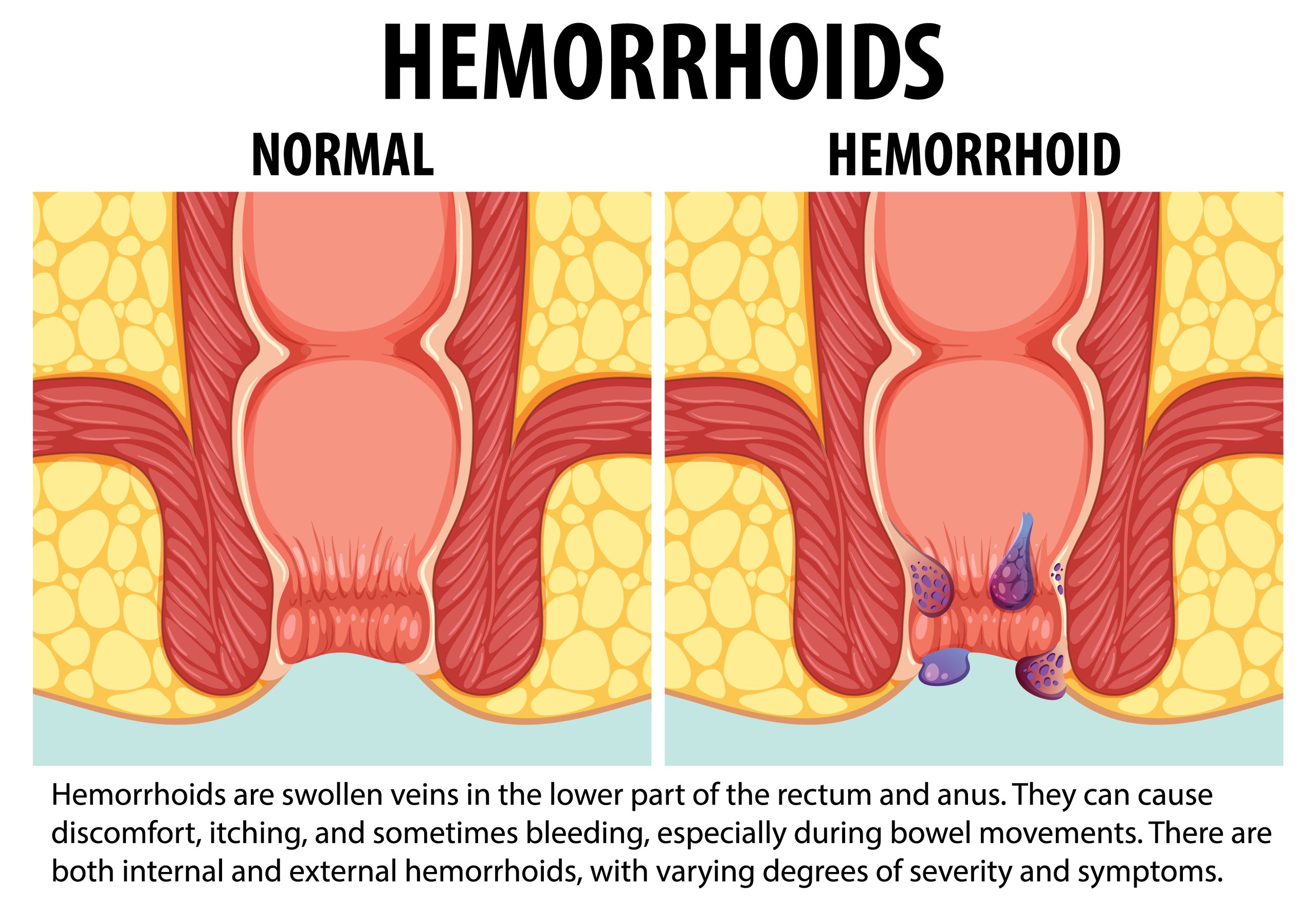 Hemorrhoids Herbal Support
